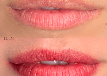 Fotos del antes y después micropigmentación de labios