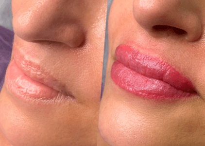 Fotos del antes y después micropigmentación de labios